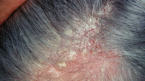 Seborrheás dermatitis
