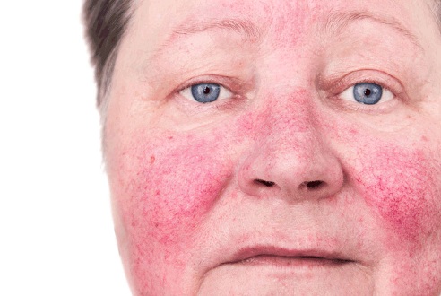 Hududslæt og forårsager rosacea