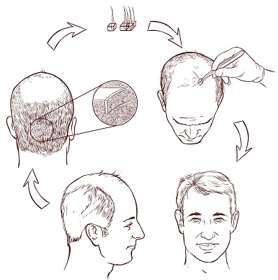 hårtransplantation-i-mumbai
