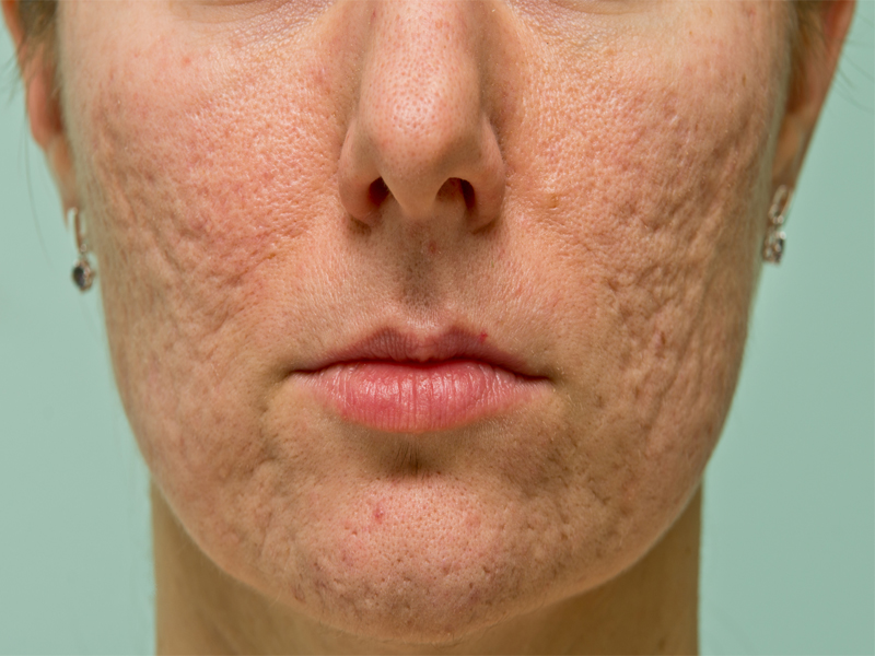 Bedste skjulere til acne ar