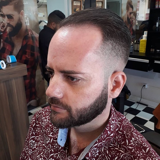 férfi minta kopaszság frizurák
