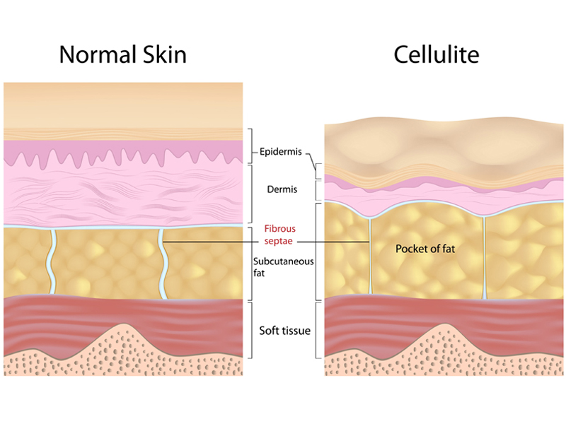 Hjemmemedicin til reduktion af cellulitter