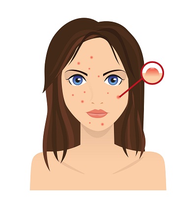 Behandlinger mod bumser - ansigt med acne