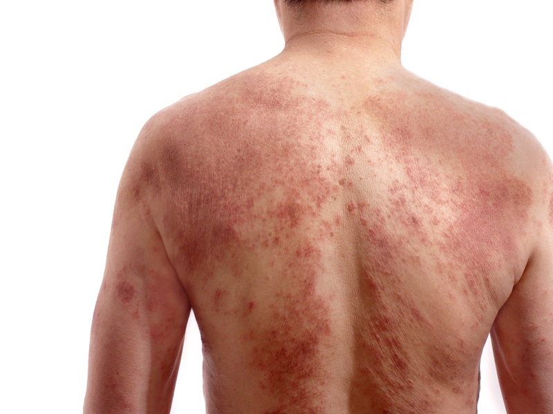 Bedste hjemmemedicin mod dermatitis