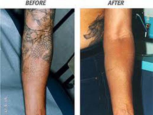 Fjernelse af halvtærmet laser tatovering