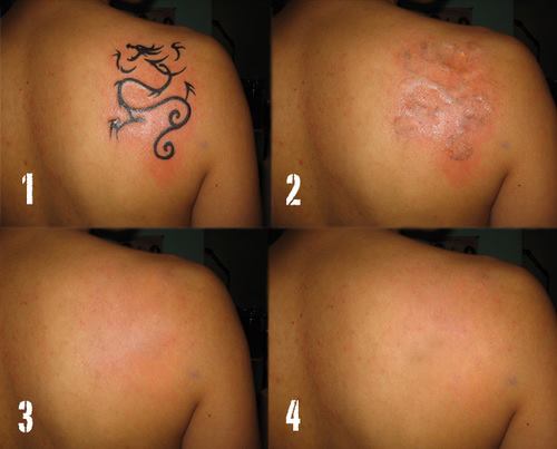 Komplet laser tatovering fjernelse