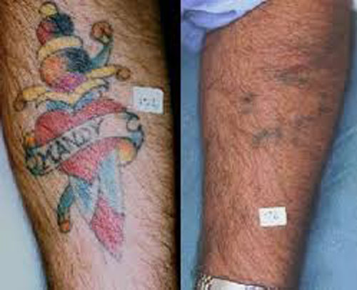 Farve tatovering fjernelse laser behandling