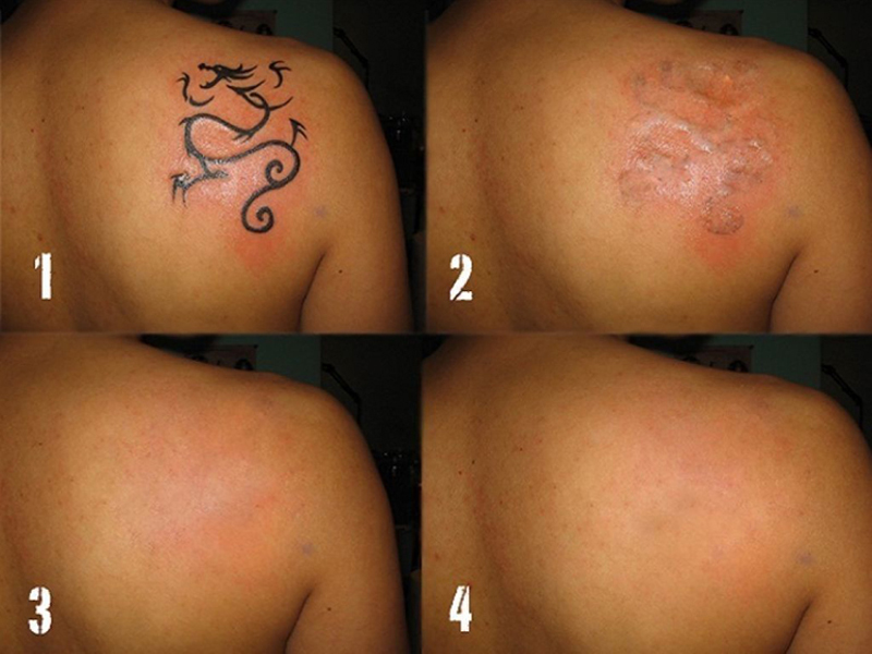 Laser tatovering fjernelse behandlinger