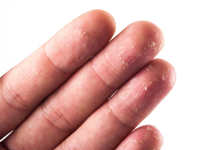 Hjemmemedicin for at slippe af med skrælning af fingerspidser