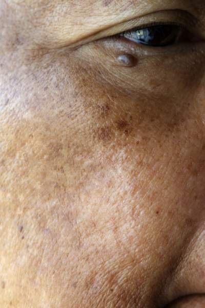 melasma házi gyógymódok