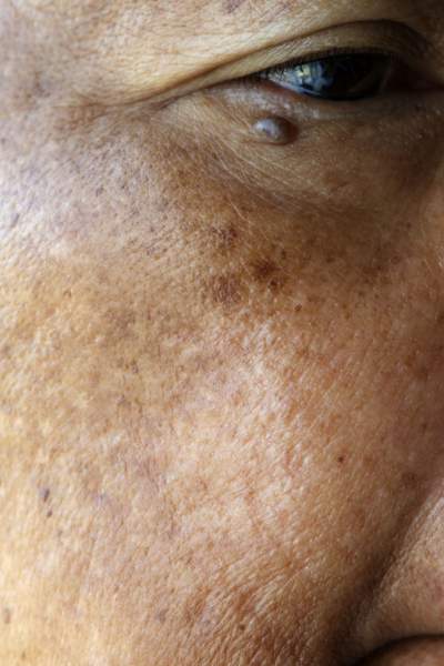 melasma hjemmemedicin