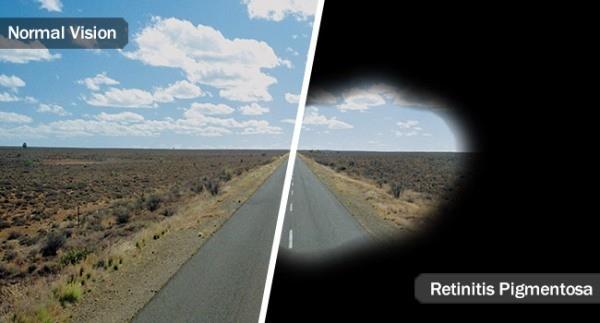 Kokeellinen implantti voi palauttaa näön sokeille retinitis pigmentosa -vaikutuksille