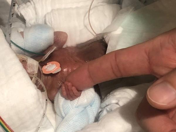 Maailman pienin vauva, joka painoi syntyessään vain 268 grammaa, menee kotiin tehohoitoon