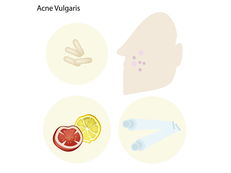 Acne Vulgaris -behandlinger derhjemme