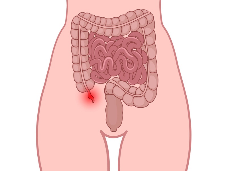 Appendicitis Smerter