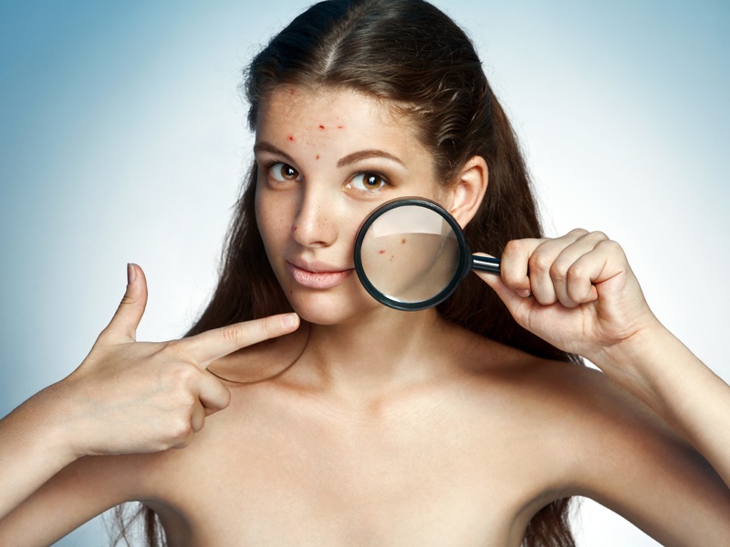 Ayurvediske behandlinger mod bumser (acne) 10 ingredienser, der virker!