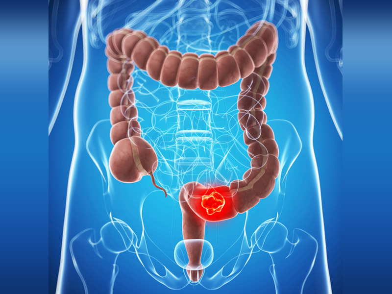 A vastagbélrák okai és tünetei