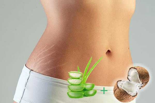 minimoi venytysmerkit kotiin korjaustoimenpiteet aloe vera kookosöljy
