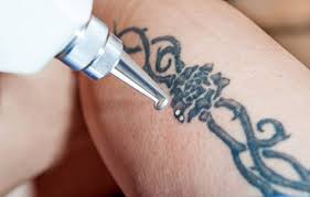 Laser til fjernelse af permanent tatovering