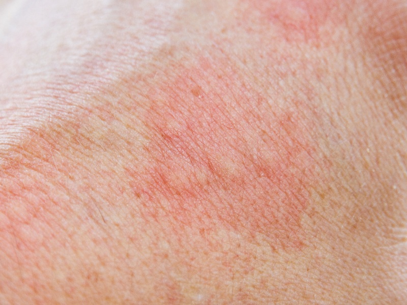 Azonnali enyhülést kaphat a bőrallergiától