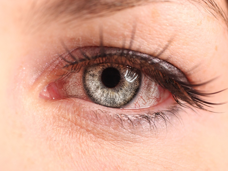 hjemmemedicin mod lyserøde øjne