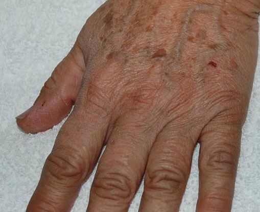 Kemisk peeling for at fjerne rynker fra hænderne