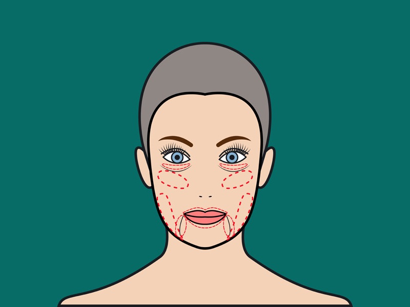 Hogyan lehet természetes módon csökkenteni az arczsírt