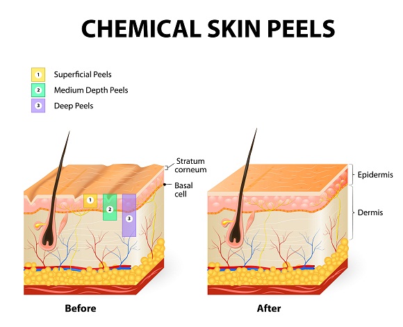 Kemisk peeling eller hudafskrabning