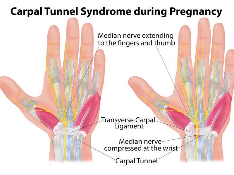 A carpalis alagút szindróma terhesség alatt