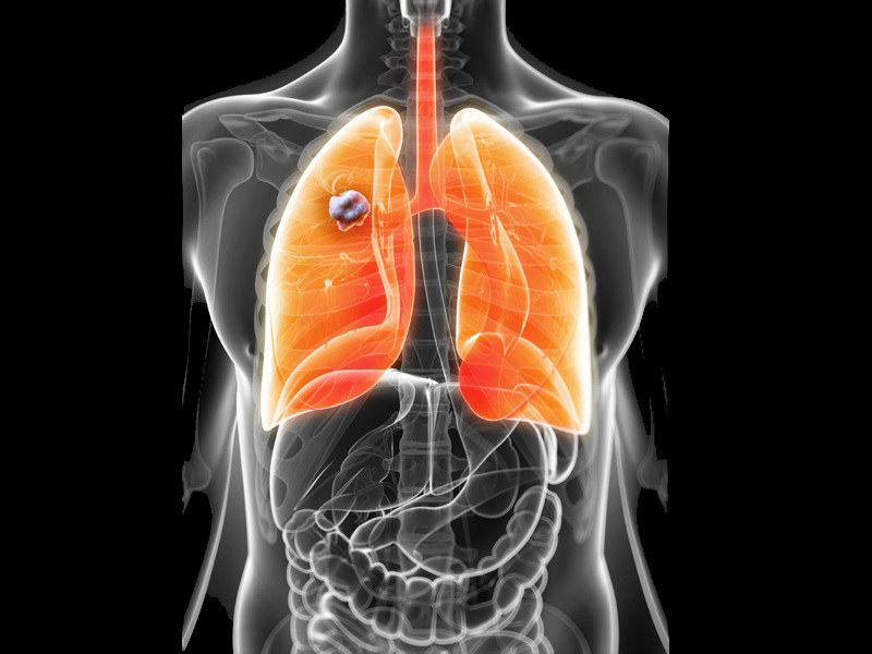 Lungekræft symptomer og årsager