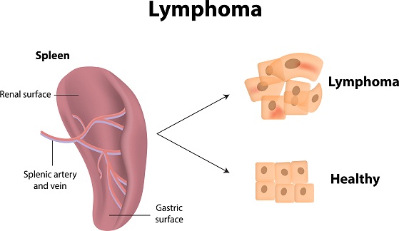 årsager og symptomer på lymfom