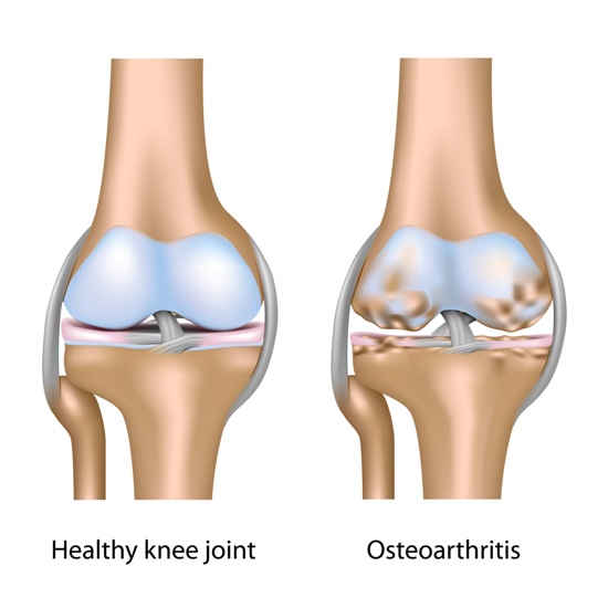 årsager og symptomer på osteoporose