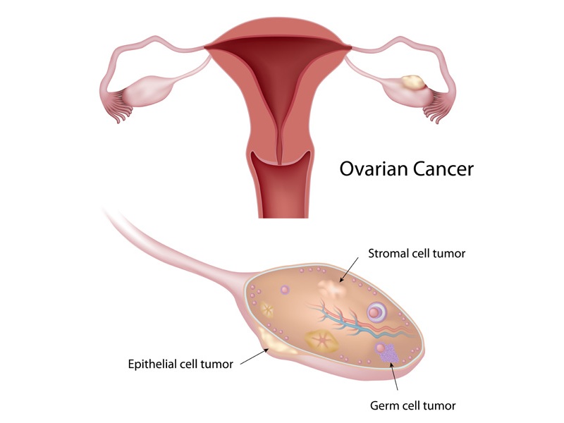 Ovariecancer under graviditeten