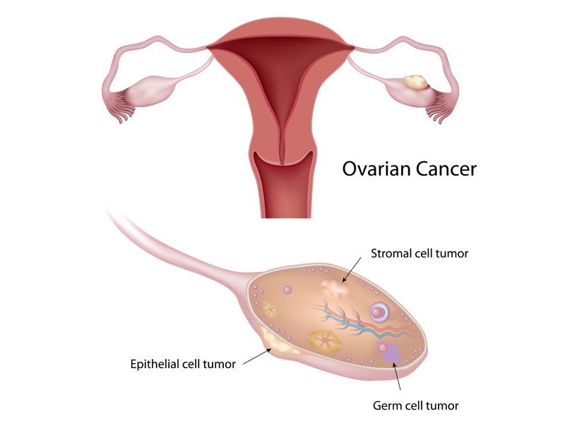 Ovariecancer symptomer og årsager