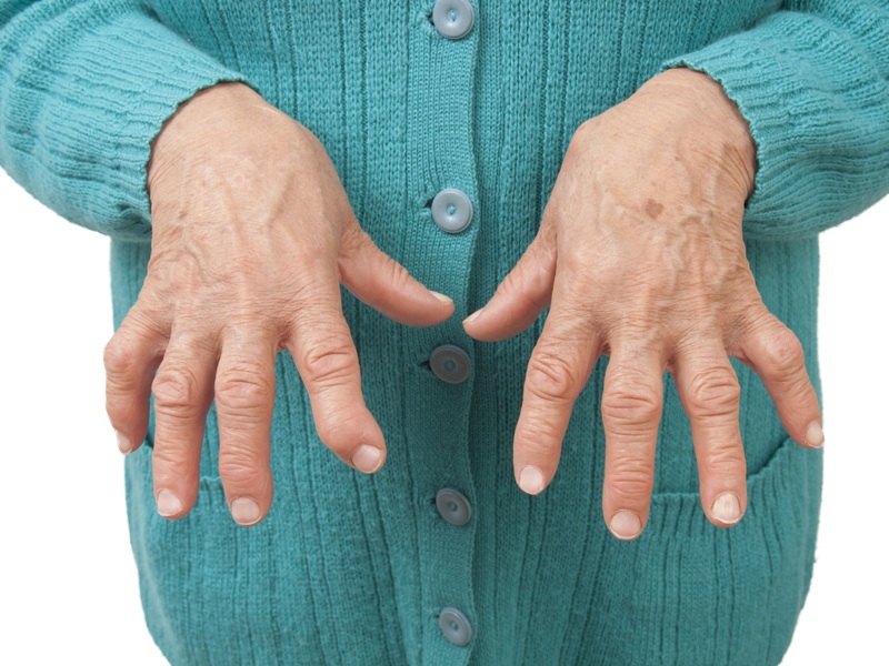 Reumatoid arthritis symptomer og årsager