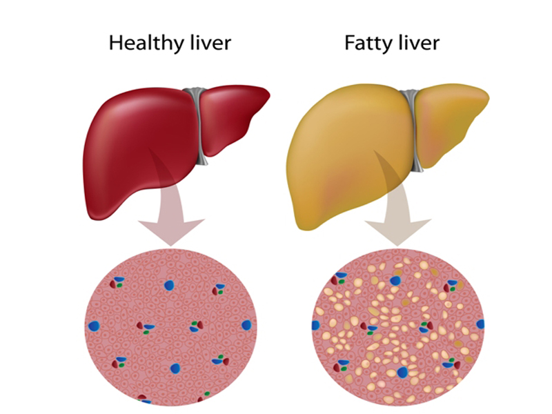 A zsíros máj okai és tünetei