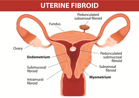 fibromer