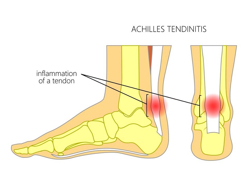 otthoni jogorvoslatok az Achilles -ínfájdalom ellen