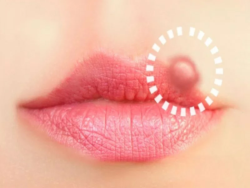 Årsager og symptomer på herpes