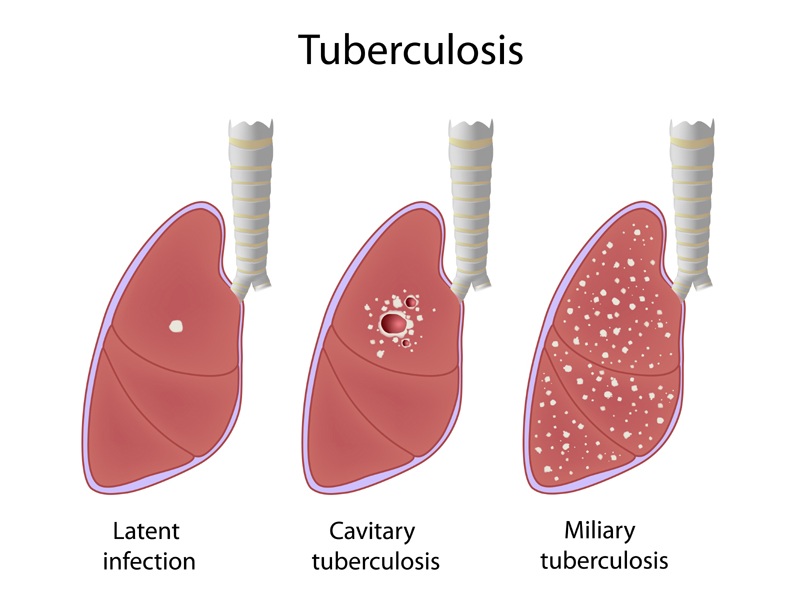 A tuberkulózis (tb) tünetei és okai