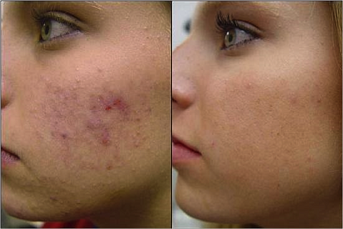 Møde hudlægen for cystisk acne