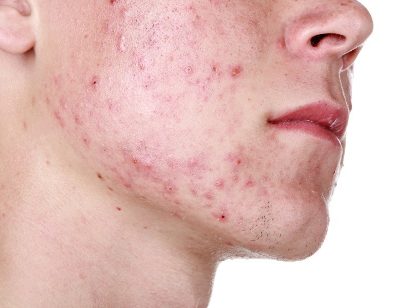 Hvad er cystisk acne og hvorfor er det forårsaget