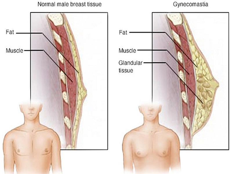 Mi a Gynecomastia (férfi mellek)