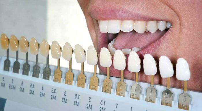 hampaiden valkaisuideoita valkoiset hampaiden valkaisumenetelmät kirkkausasteikko