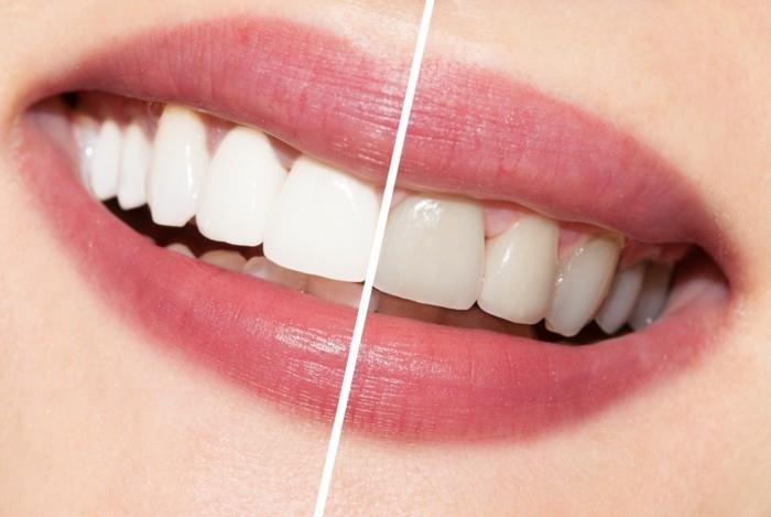 hampaiden valkaisu-ideat-valkoiset-hampaiden valkaisumenetelmät-valkaisu